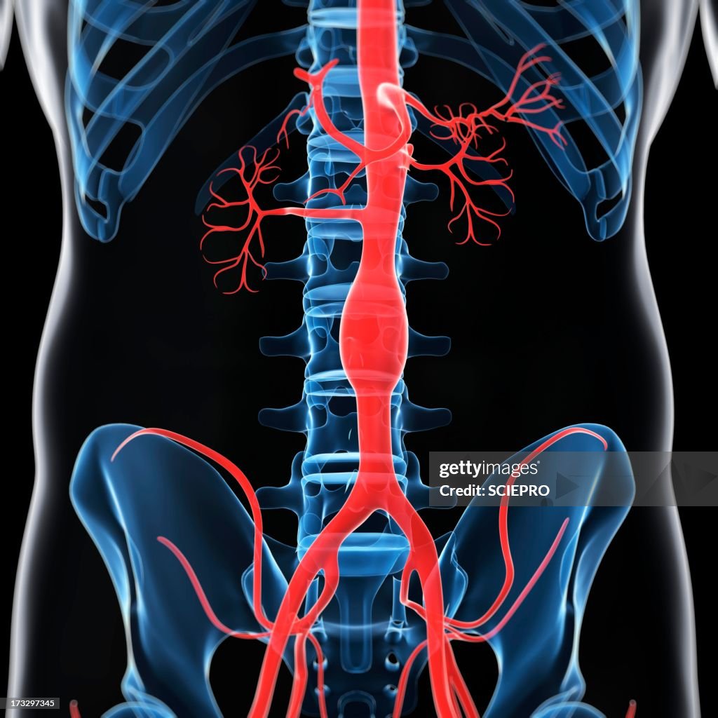 Aortic aneurysm, artwork