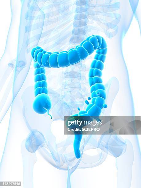 diverticulosis, artwork - abdominal hernia stock illustrations