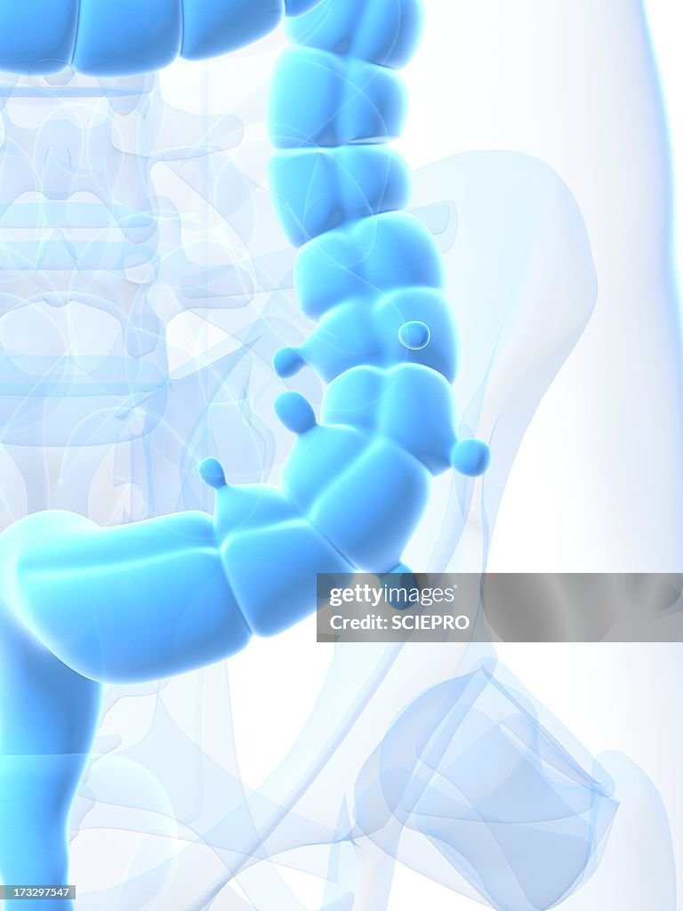 Diverticulosis, artwork