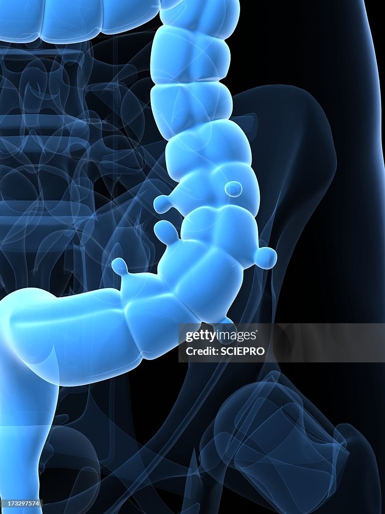 Diverticulosis, artwork