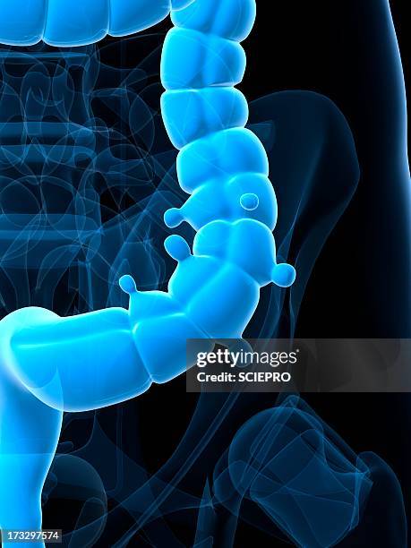 diverticulosis, artwork - abdominal hernia stock illustrations