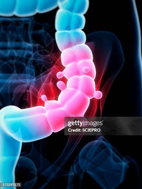 diverticulosis, artwork - abdominal hernia stock illustrations