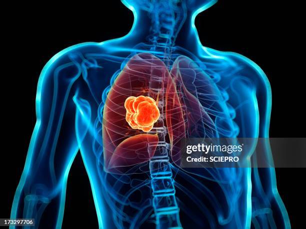 illustrazioni stock, clip art, cartoni animati e icone di tendenza di lung cancer, artwork - polmone