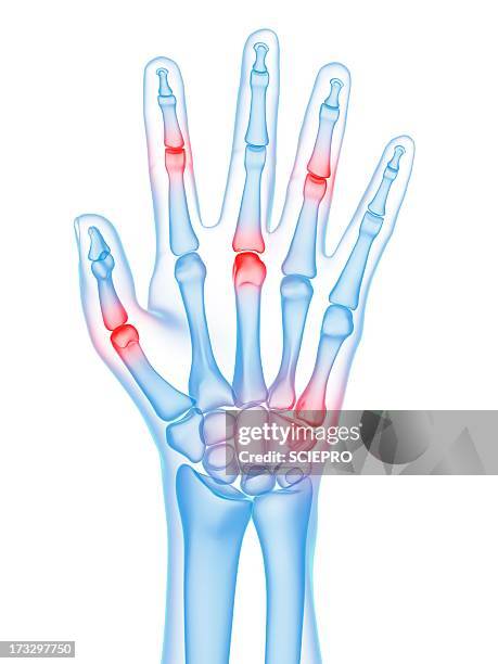 ilustraciones, imágenes clip art, dibujos animados e iconos de stock de hand joint pain, conceptual artwork - radio hueso del brazo