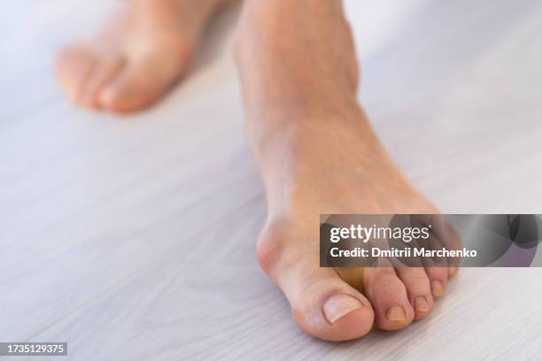 valgus deformity of foot with bone protrudes on foot at base of thumb, closeup view. - valgus stock pictures, royalty-free photos & images