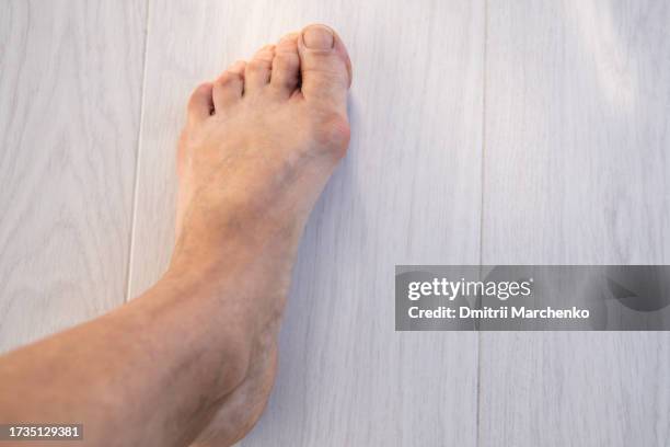 hallux valgus deformity of female foot with bone protrudes at base of leg thumb, close-up view. - valgus stock pictures, royalty-free photos & images