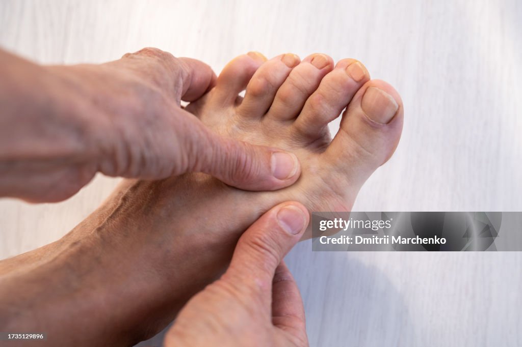 Female touching massaging hallux valgus deformity of foot with bone protrudes at base of thumb.