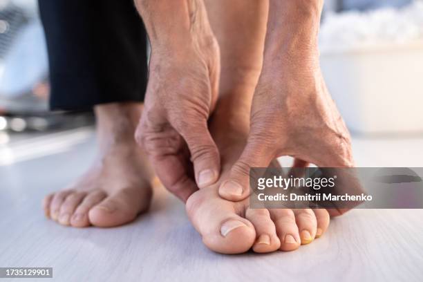 female touching valgus deformity of foot with bone protrudes on foot at base of thumb, close-up view. - hallux valgus stock pictures, royalty-free photos & images