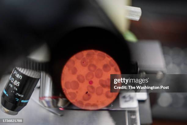 Microscope samples show the presence of the malaria virus, plasmodium falciparum, at the Manhiça Health Research Center on August 16 in Manhiça,...