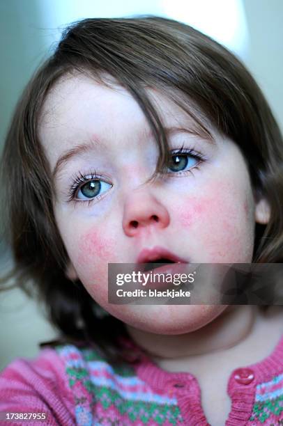 scarlet fever - scarlet fever child stock pictures, royalty-free photos & images