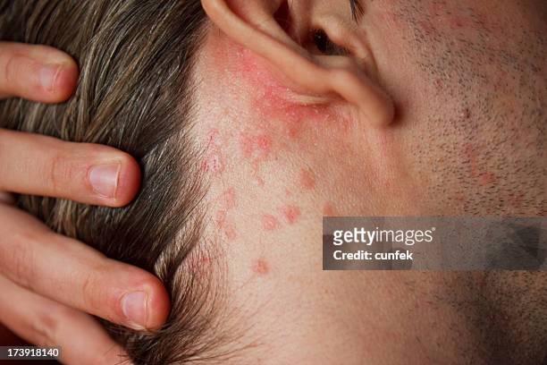 rash - dermatitis stock pictures, royalty-free photos & images