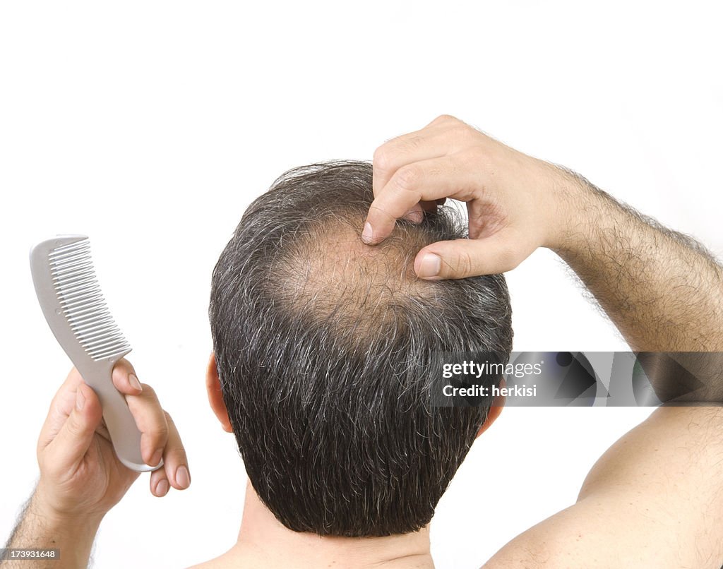 Balding