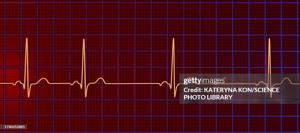 Sinus Arrhythmia Heartbeat Rhythm Illustration High-Res Vector Graphic ...