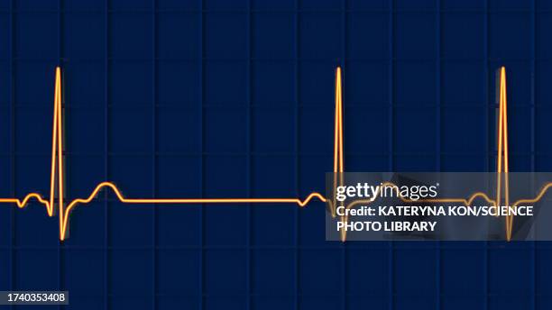 sinus arrhythmia heartbeat rhythm, illustration - cardiac arrhythmia stock illustrations