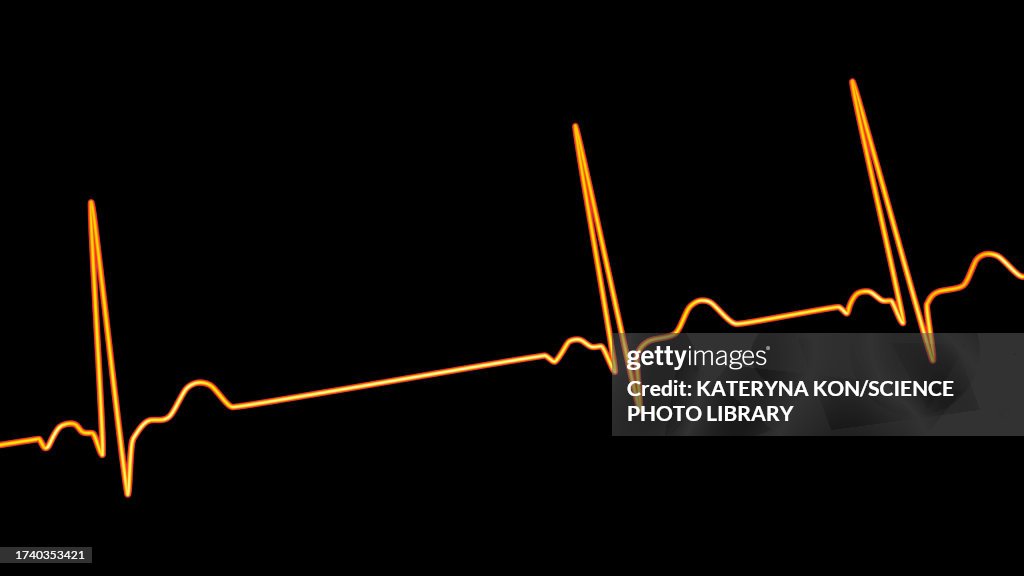 Sinus Arrhythmia Heartbeat Rhythm Illustration High-Res Vector Graphic ...