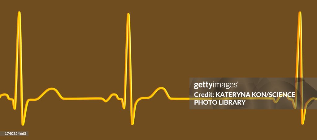 Sinus Arrhythmia Heartbeat Rhythm Illustration High-Res Vector Graphic ...