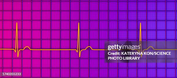junctional rhythm of the heartbeat, illustration - lopsided stock illustrations