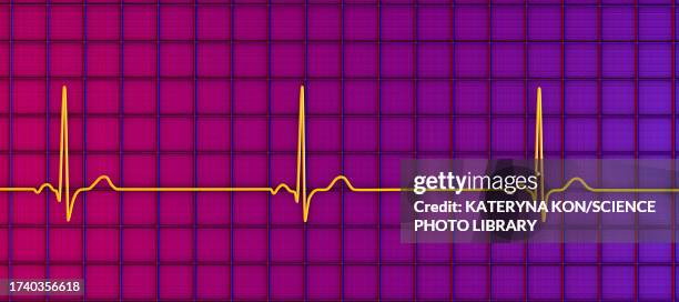 sinus bradycardia heartbeat rhythm, illustration - pulse trace stock illustrations