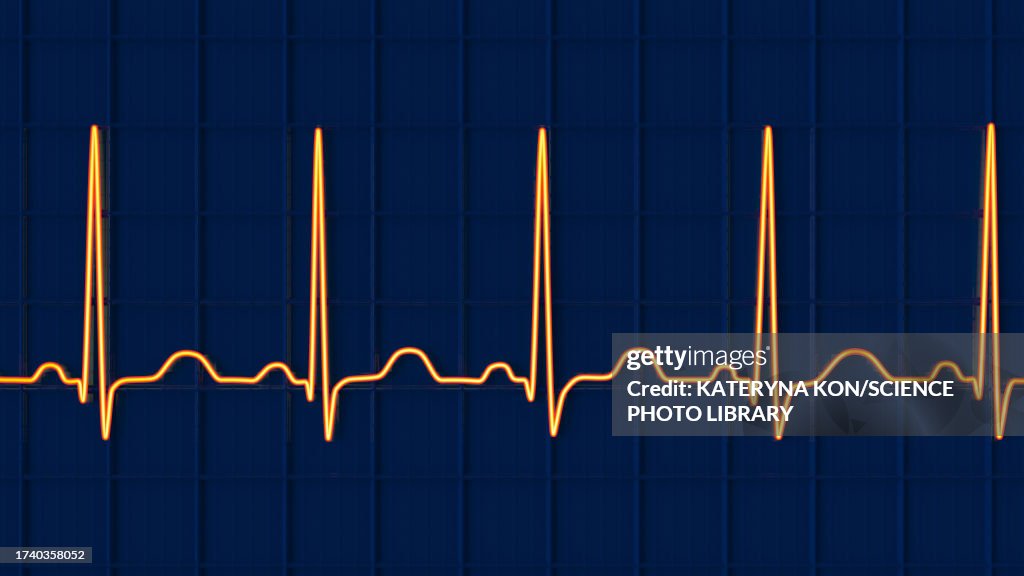 Sinis Rythmn Sinus Tachycardia Heartbeat Rhythm Illustration High-Res Vector Graphic ...