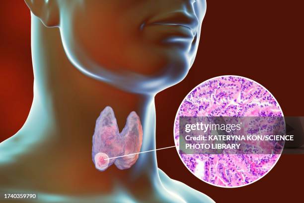 thyroid cancer, illustration - 光学顕微鏡図点のイラスト素材／クリップアート素材／マンガ素材／アイコン素材