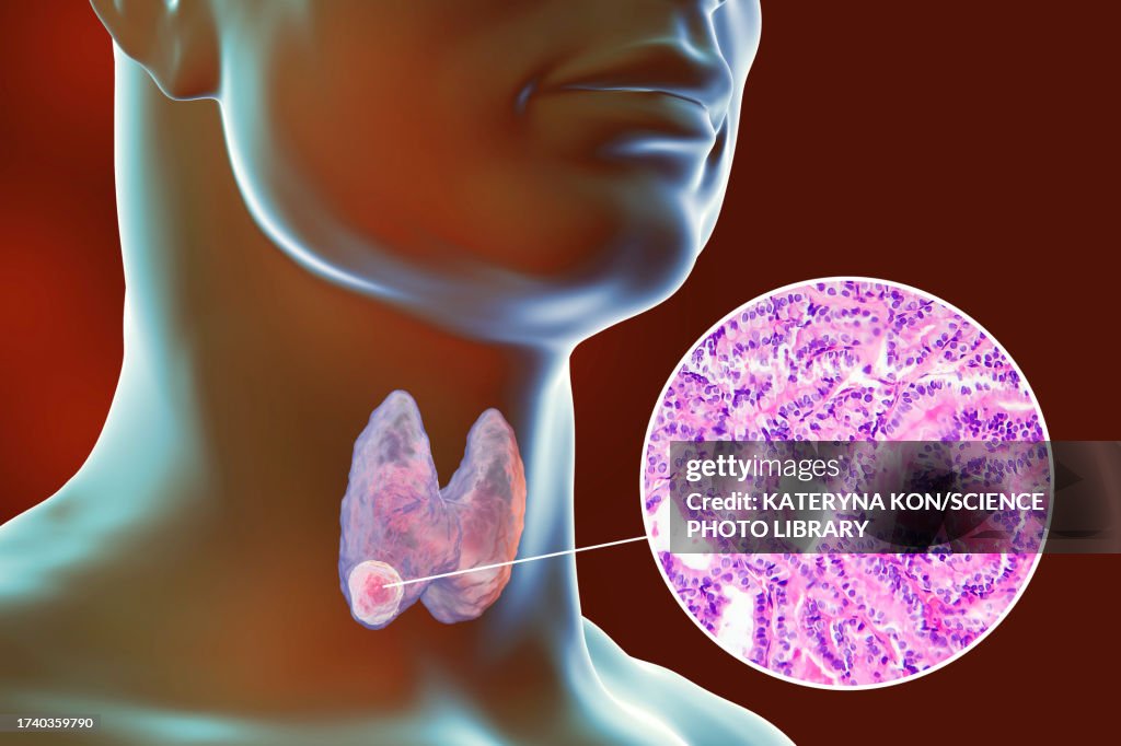 Thyroid cancer, illustration