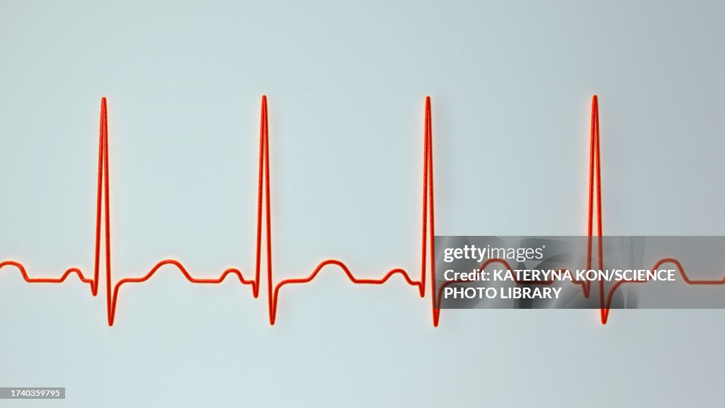 Sinis Rythmn Sinus Tachycardia Heartbeat Rhythm Illustration High-Res Vector Graphic ...