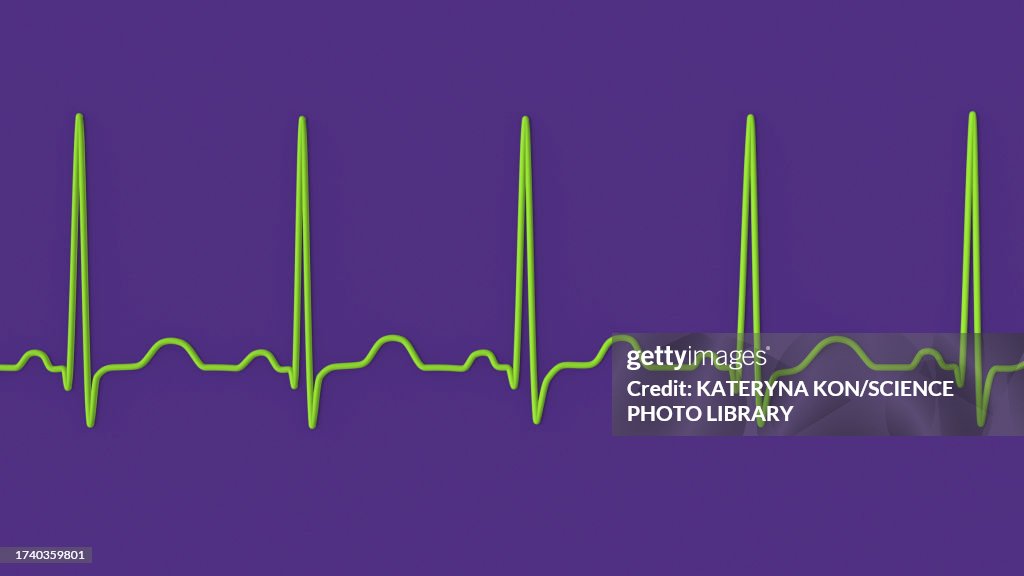 Sinis Rythmn Sinus Tachycardia Heartbeat Rhythm Illustration High-Res Vector Graphic ...