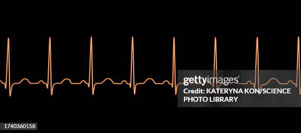 Sinus Tachycardia Heartbeat Rhythm Illustration High-Res Vector Graphic ...