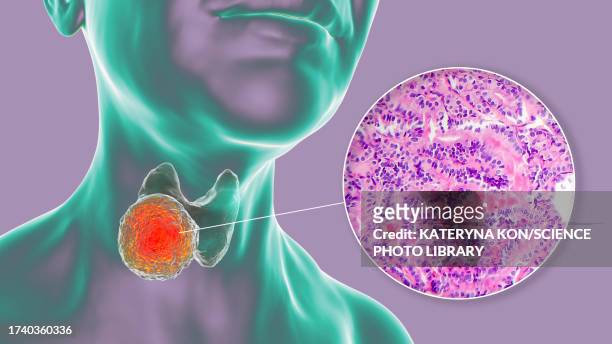 thyroid cancer, illustration - human gland stock illustrations