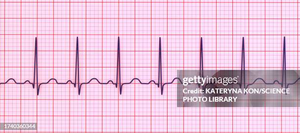 sinus tachycardia heartbeat rhythm, illustration - medical supplies stock illustrations