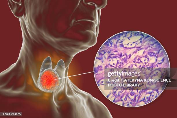 thyroid cancer, illustration - human gland stock illustrations