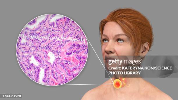 woman with thyroid cancer, illustration - 光学顕微鏡図点のイラスト素材／クリップアート素材／マンガ素材／アイコン素材