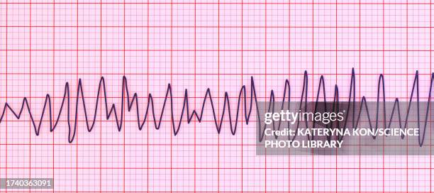 ilustrações de stock, clip art, desenhos animados e ícones de torsades de pointes heartbeat rhythm, illustration - ataque cardíaco