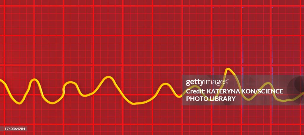 Ventricular fibrillation heartbeat rhythm, illustration