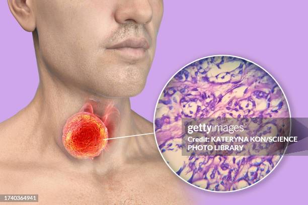 man with thyroid cancer, illustration - histology stock illustrations