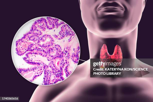 thyroid cancer, illustration - histology stock illustrations