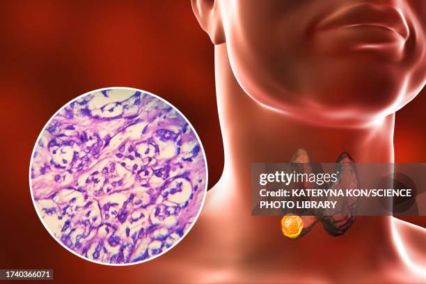 illustrazioni stock, clip art, cartoni animati e icone di tendenza di thyroid cancer, illustration - tiroide