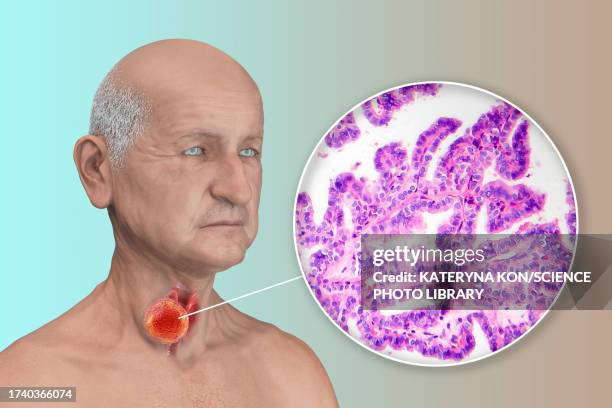 man with thyroid cancer, illustration - light micrograph stock illustrations