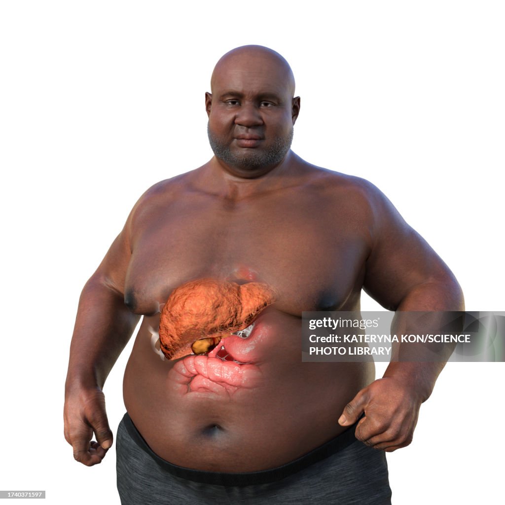 Overweight man with steatosis, illustration