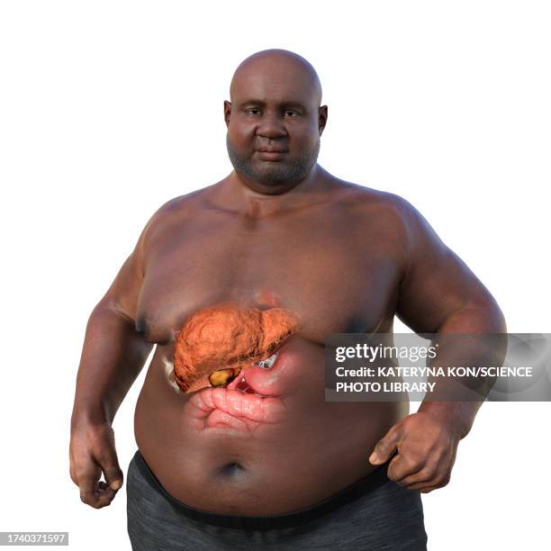 overweight man with steatosis, illustration - human build stock illustrations