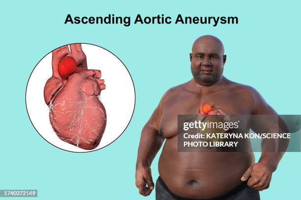 obese man with ascending aortic aneurysm, illustration - cardiomyopathy stock illustrations