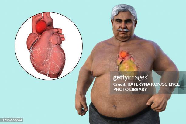 obese man with ascending aortic aneurysm, illustration - dilation stock illustrations