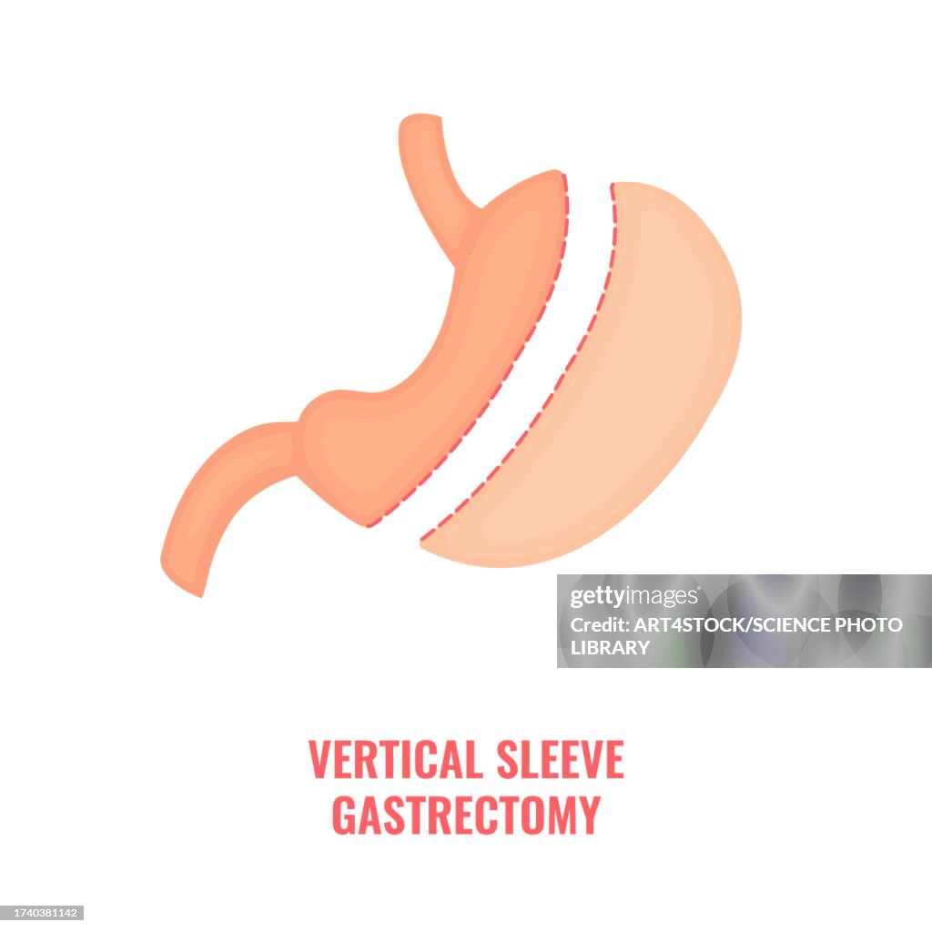 Vertical sleeve gastrectomy, illustration