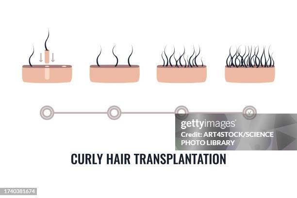 curly hair transplantation, illustration - personal hygiene product stock illustrations