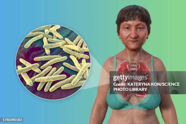 cavernous tuberculosis, illustration - hollow body stock illustrations