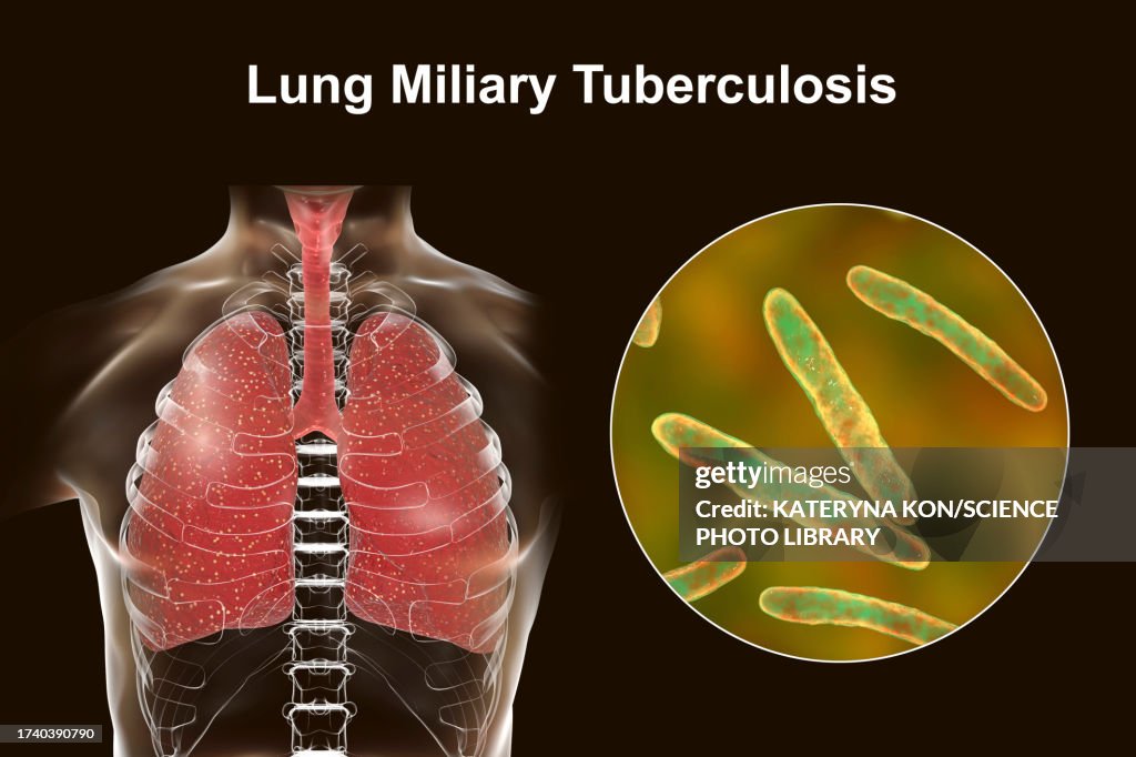 Lungs affected by miliary tuberculosis, illustration