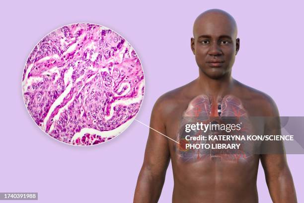 lung cancer, illustration - histology stock illustrations