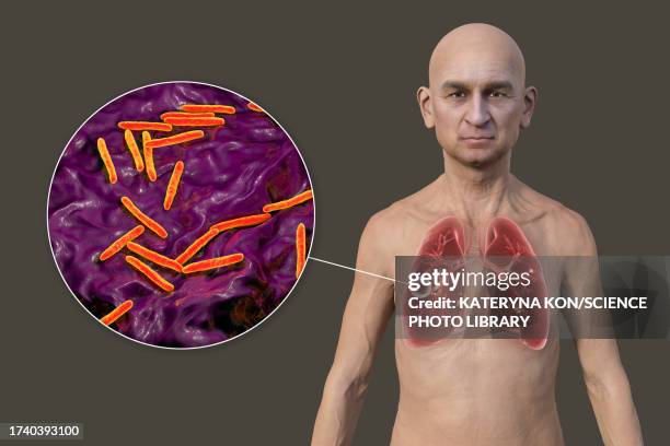 cavernous tuberculosis, illustration - man difficulty breathing stock illustrations
