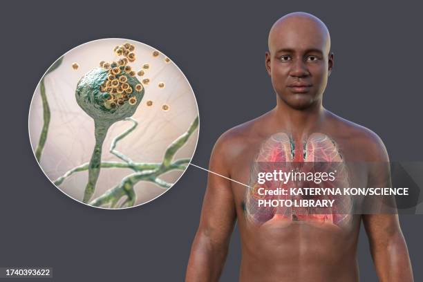 lung mucormycosis lesion, illustration - rhizopus stock illustrations