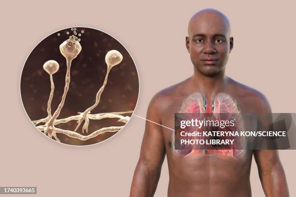 bildbanksillustrationer, clip art samt tecknat material och ikoner med lung mucormycosis lesion, illustration - zygomykos